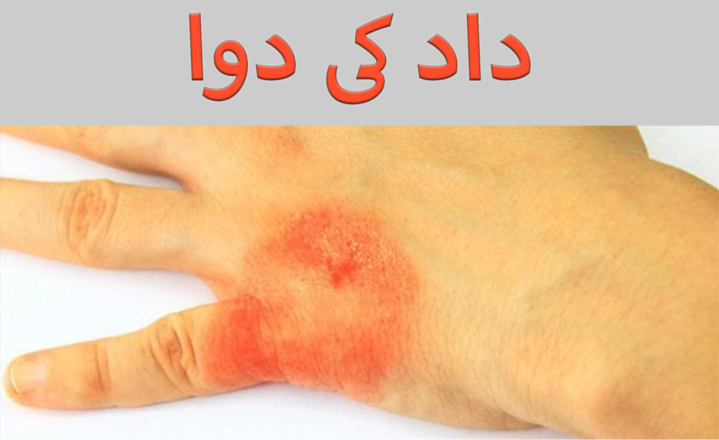 Ringworm Home Treatment In Urdu